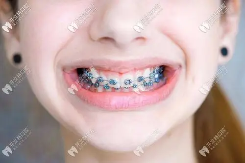谁知道龅牙矫正后能改善齿性龅牙下巴后缩吗?怎么矫正好