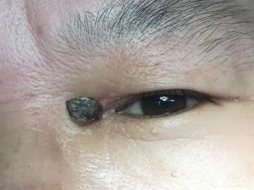 眼睑内眦肿物一粒 [病例帖]