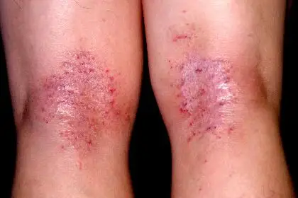 过敏性皮炎临床表现是什么?