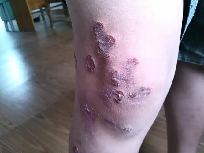 皮肤外科脓疱疮