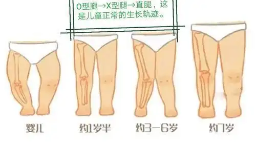 孩子走路内八字需要纠正吗