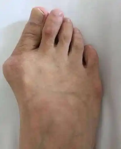 别了又丑又痛又磨人的大脚骨