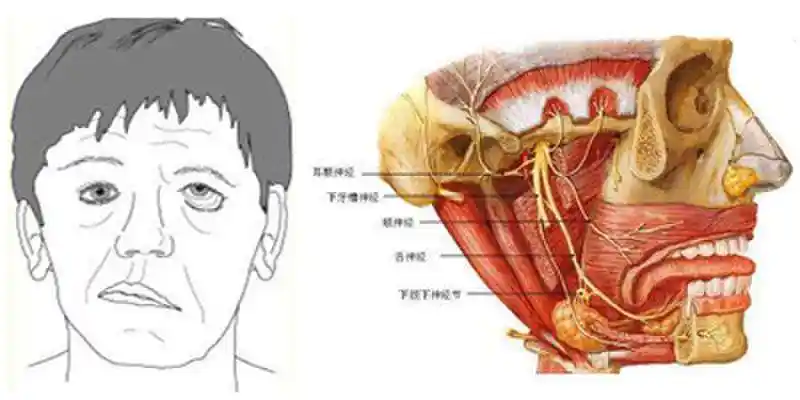 面神经炎的常见发病原因