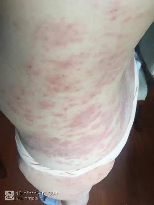 分享关于我在孕期得丘疹性荨麻疹和湿疹的经历