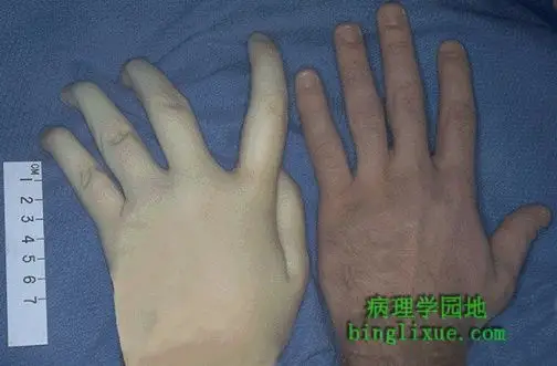 马凡综合征蜘蛛样指