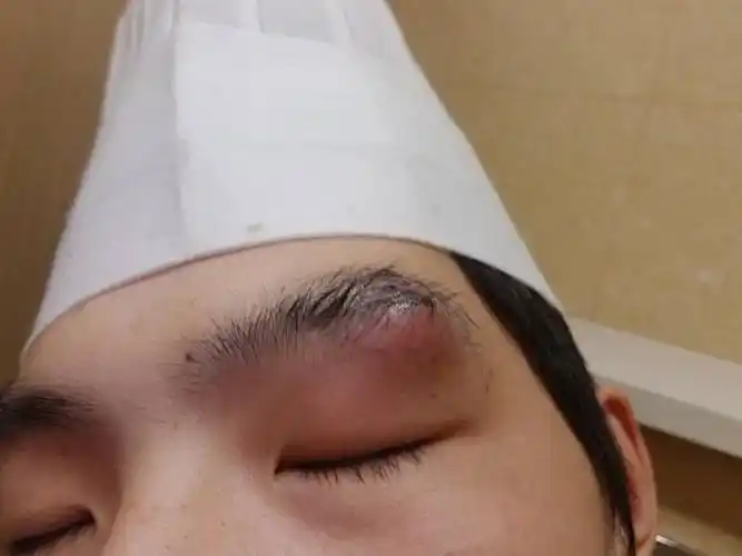 疖子红肿疼痛,已经一个星期了