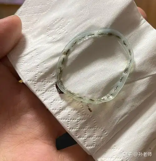 环切手术愈合多久后钉子开始脱落