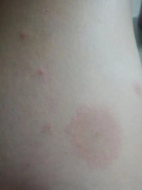 腿上起红斑,一开始是红点,慢慢的越长越大,往外扩散,不疼不痒,这是