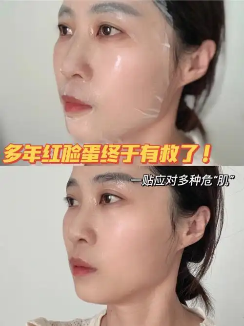 多年红脸蛋终于有救啦75