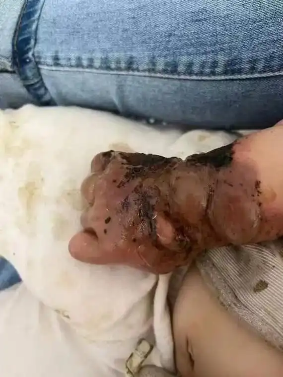 皮肤烧伤.九个多月,小朋友不小心被热开水烫伤,正在修复中,关 - 抖音