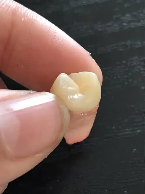 从此以后我就是个没双尖牙的人了