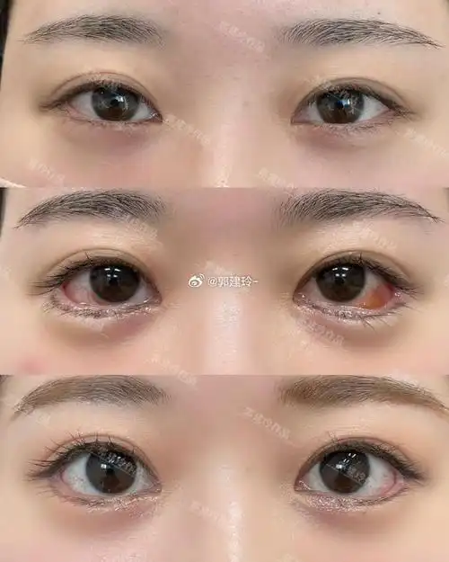 北京眼睑下至##北京眼部整形