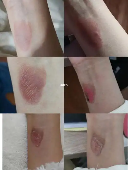 被烫伤的第十二天