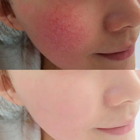 【拍3送1】玛雅帕帕拉面膜贴非晒后敏感肌肤红血丝抗敏感