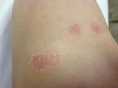 银屑病的早期的症状表现图