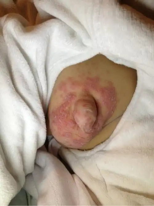 宝宝湿疹怎么反反复复