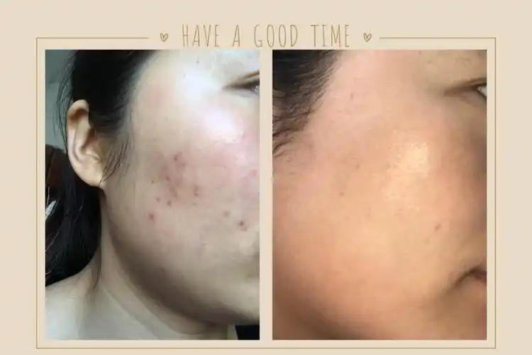 其它 拨经护肤前后对比,拨经美容相关话题 写美篇由于,秋冬季节皮肤