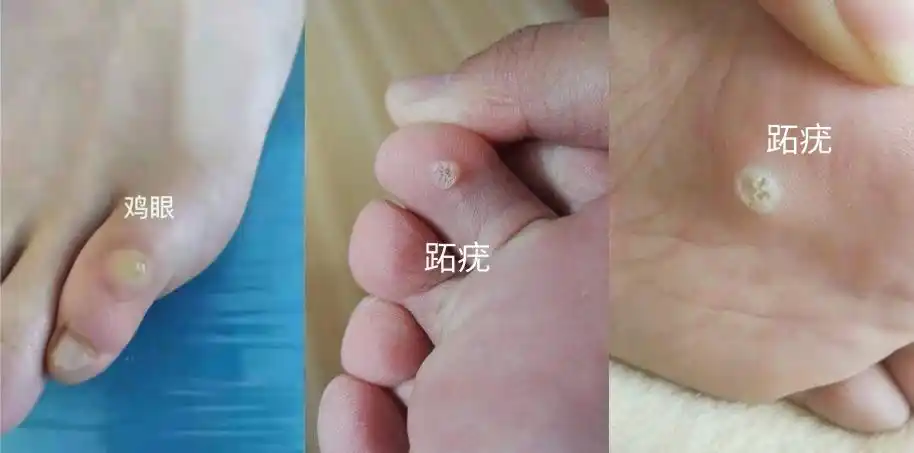 鸡眼,跖疣傻傻分不清?靳医生教你这几个关键点!