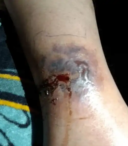 被它咬了一口布村大叔4周9次手术小腿仍惨遭截肢华人注意这种生物在