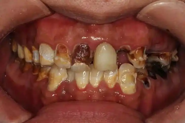 当牙齿渐渐腐烂,文文每天晚上都会因为牙痛疼醒,她眼睁睁看着一口白牙