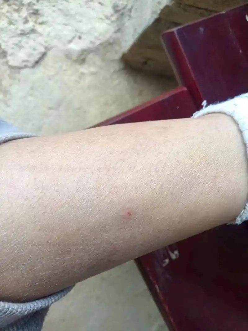 被家里的三个月大的小狗咬了,小伤口,要打疫苗吗