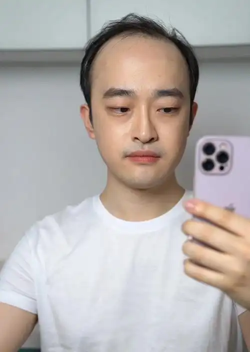 秃头男士如何拥有帅气发型,快速改变形象,告别脱发?