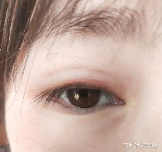 突然上眼皮就肿起来了,而且又痛又痒,眨眼都痛,现在眼睛已经肿的特别