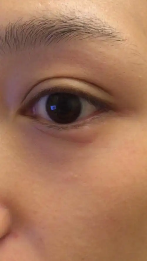 下眼睑长小包,偶尔长 过一小时左右又会消.