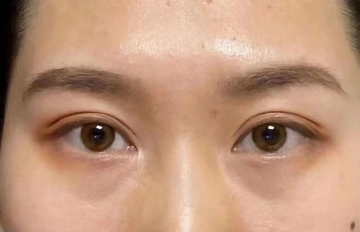 填充泪沟7天后效果图 一般来说,填充泪沟后可以平整下眼睑内侧的组织