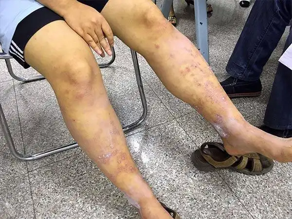 陈连军教授:"这位患者腿上的皮肤病算是疑难杂症了,是两种疾病的共同