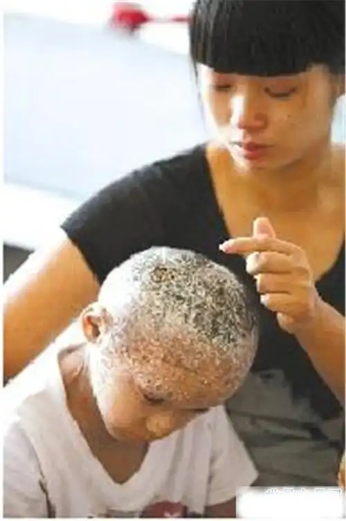 世界最奇怪的病这种病太恐怖了简直头皮发麻