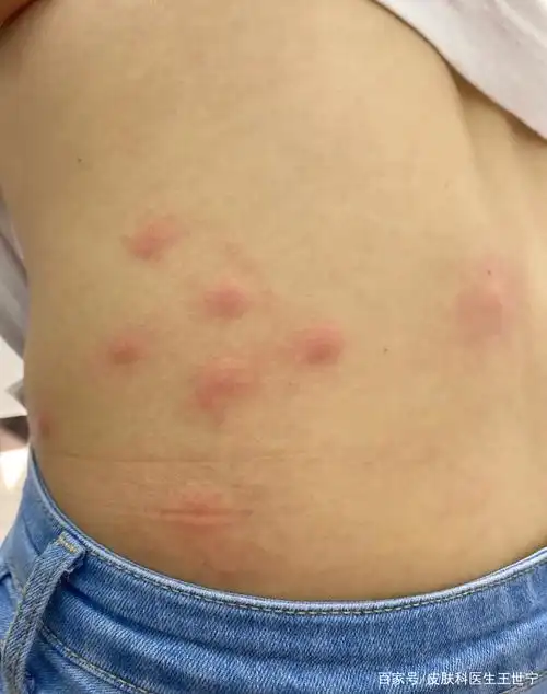 丘疹性荨麻疹怎么办!