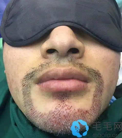 成都丝恒植发胡须案例 - 毛毛网