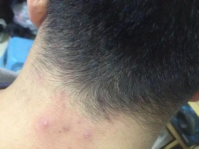 后面脖子上这个是什么东西啊,是什么原因造成的,用什么方法治疗?