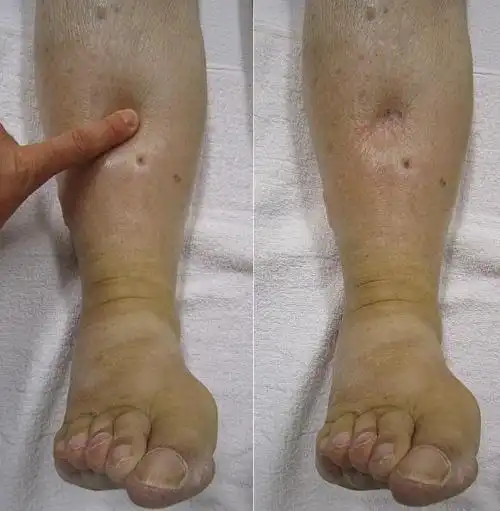 糖尿病肾病水肿严重图片