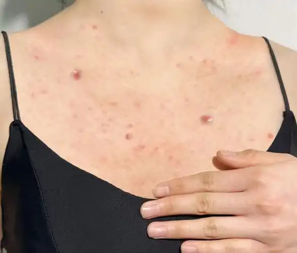 顽固痘痘已断根脓包粉刺洗洗就掉前胸后背终于恢复光滑