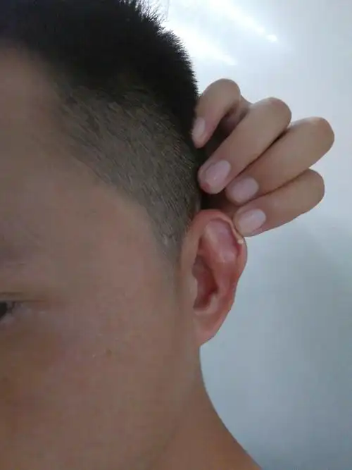 耳朵上耳廓处长了一个白色的包,不痛不痒,请问是什么?