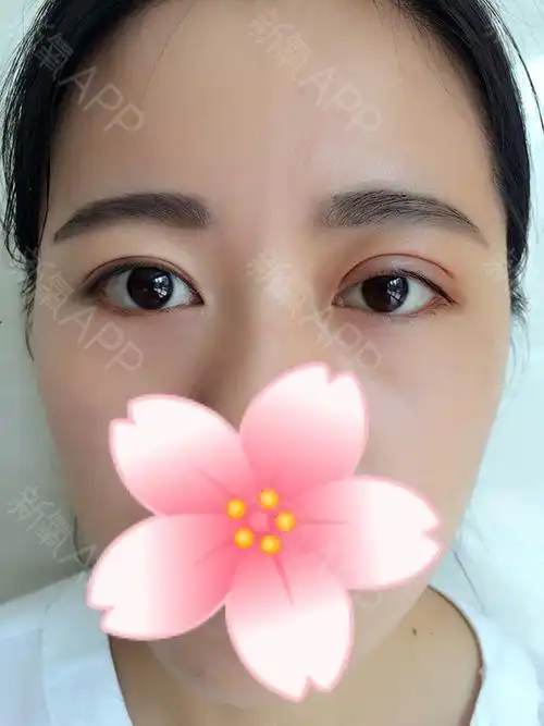 埋线双眼皮好不好_效果图_长情a埋线双眼皮术后第2天_新氧美容整形