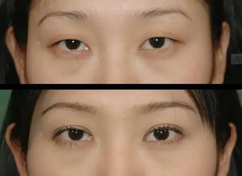 割双眼皮前后对比图