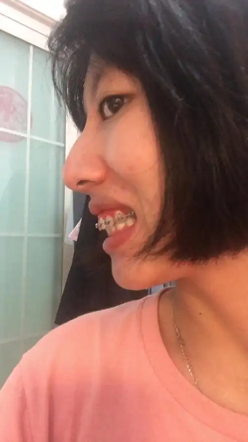 这个侧面上牙还需要收一点吗