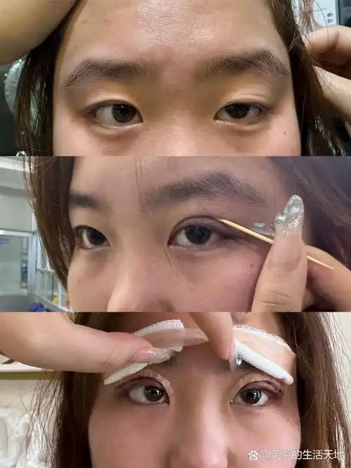 提肌无力的眼睛眼睛很多年了 一只眼睛这样 让我很尴尬 今天终于 狠狠