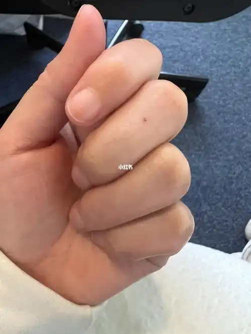 左手中指有红痣