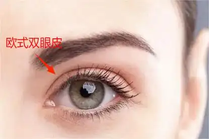 欧式双眼皮