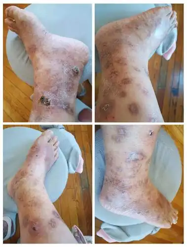 郭淑汾医师 | 小腿反复溃烂3年_手机搜狐网