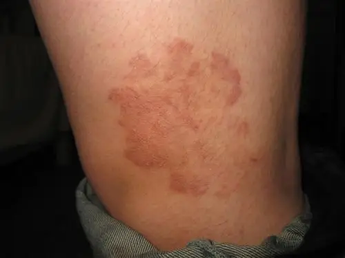 看图识病------体癣