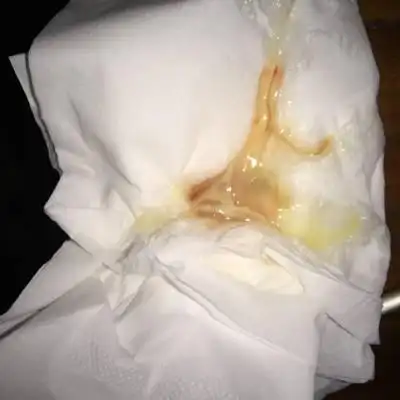 39周3天 有不规律的宫缩 上厕所见粘稠的分泌物带血丝 这样是有多久生