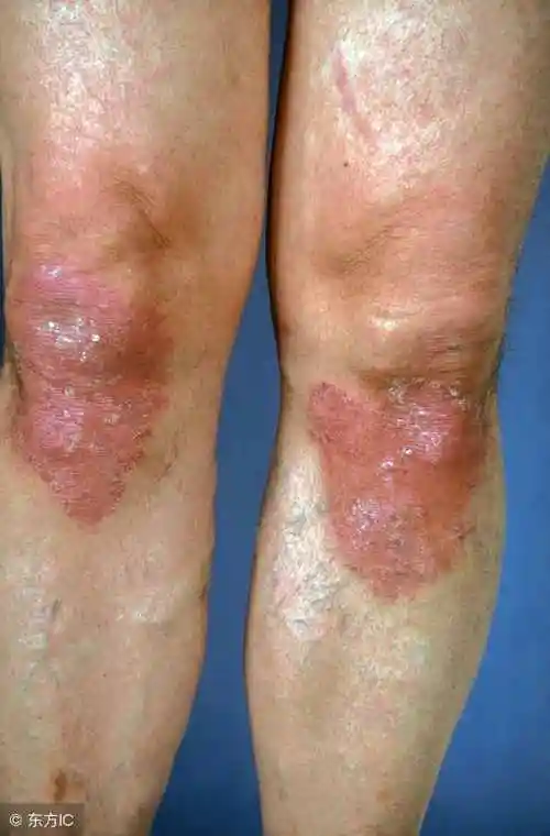 从症状描述上看像这种情况是颈部皮肤癣具体表现是日光性皮炎所导致的