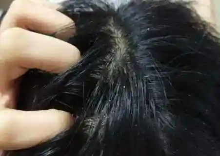 头发有螨虫,怎么除去?