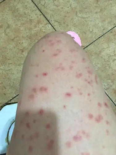 孕后期得了妊娠痒疹,是不是生了就好了,有没有宝妈得过啊?