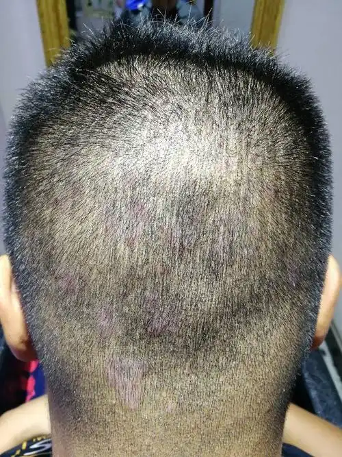 我的头皮上面有红斑,一片一片的,请问大伙这是什么啊